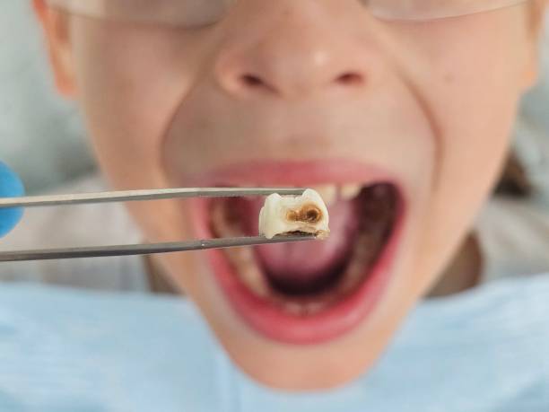 Best Emergency Dentist for Knocked-Out Tooth in Sharonville, OH