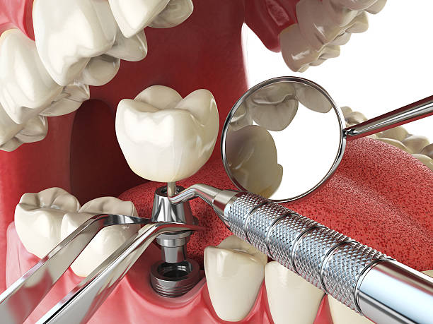 Best Emergency Dental Care for Abscessed Tooth in Sharonville, OH